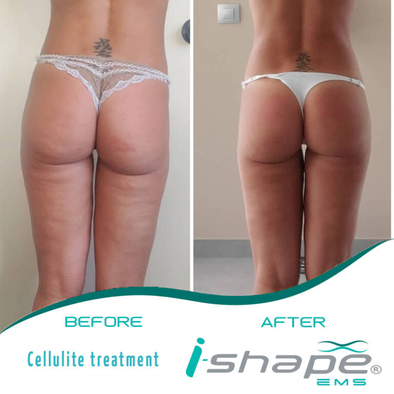 cellulite